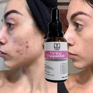 Tonico Despigmentante 🇨🇴 *Eliminador de manchas* Removes dark spots + ac…